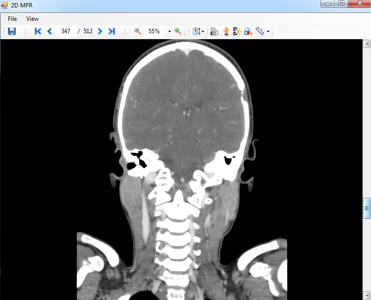 Screenshot of image viewer, which displays a coronal DICOM MPR slice